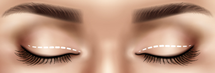 A imagem mostra a ilustração de um par de olhos fechados com a marcação de como será feita a blefaroplastia superior.