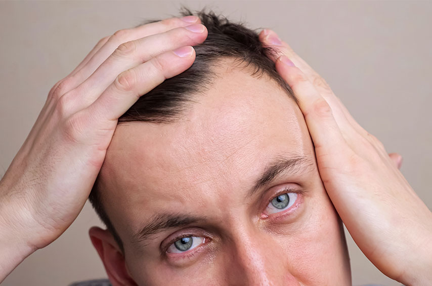 A imagem mostra um homem de pele clara e olhos azuis olhando as falhas de cabelo no topo lateral da sua cabeça. Ele separa com as duas mãos a entrada dos cabelos.