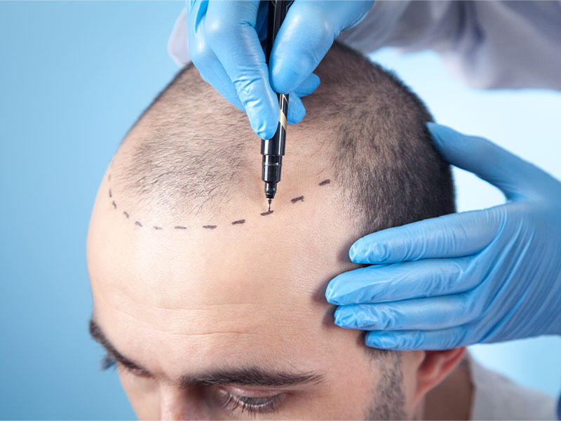 A imagem mostra o topo da cabeça de um homem com calvície. É possível ver as mãos do médico vestindo luvas azuis e fazendo uma marcação com uma caneta especial na cabeça do paciente. O fundo da imagem é azul.