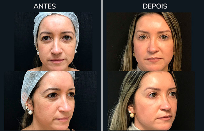 antes_depois1-1
