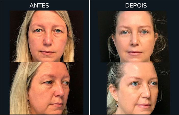 antes_depois2-1