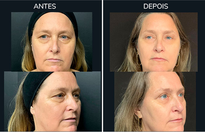 antes_depois3-1
